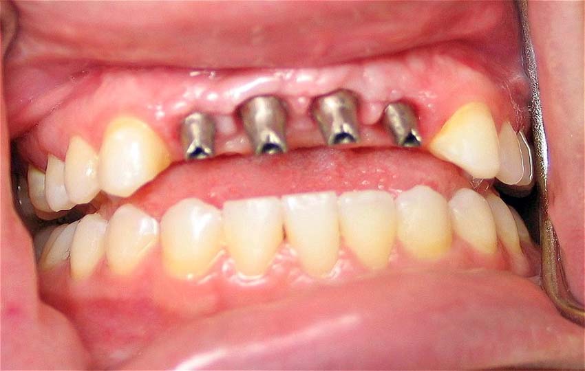 Fog Implantatum Gyakori Kerdesek
