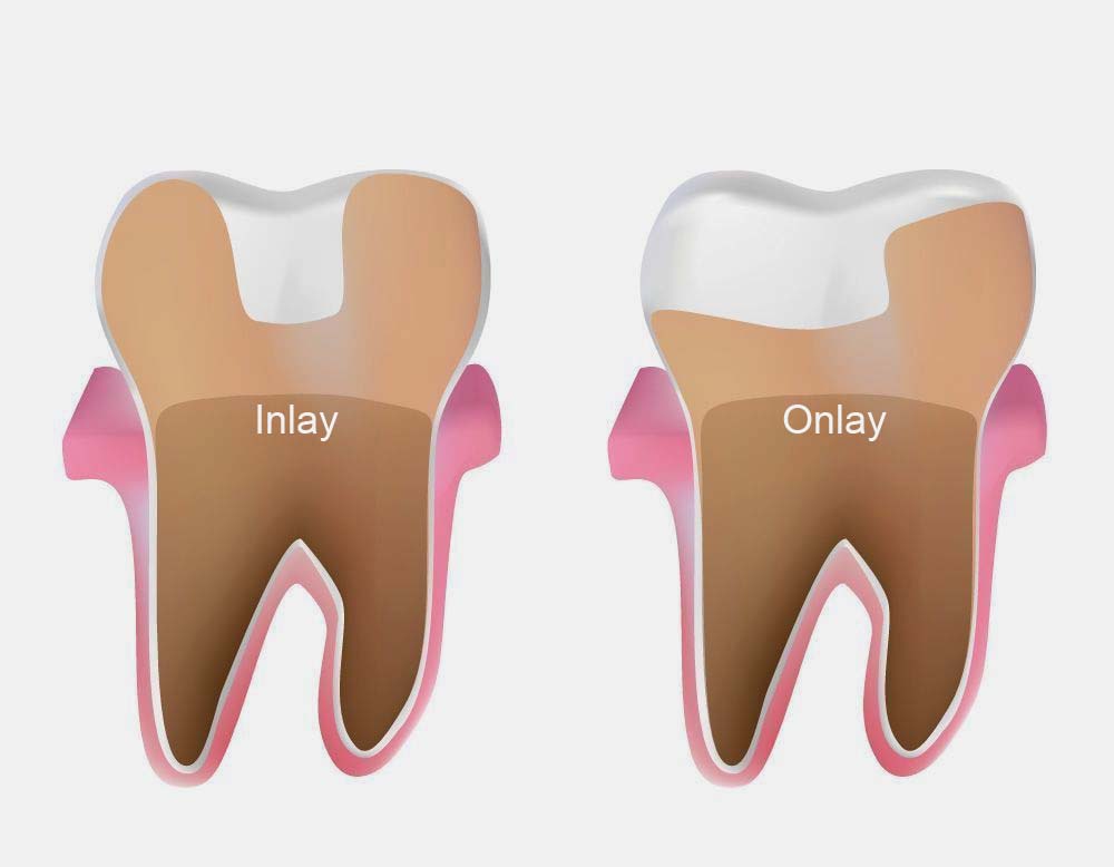 Az Inlay- vagy Onlay-ként emlegetett fogászati szakkifejezés egy bizonyos tömés, amelyet nem a fogorvos készít el a rendelőben, és nem a klasszikus tömési anyagokat használják hozzá. Ezt a tömést a fogtechnikus készíti el egy alapos lenyomat alapján.